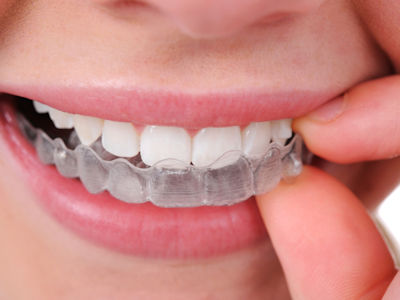 Zahnschiene gegen Zähneknirschen und Zähnepressen