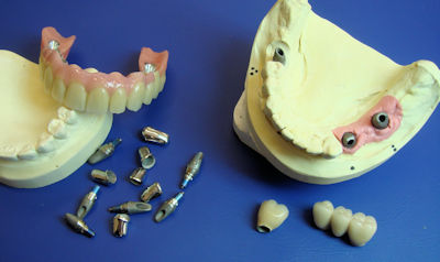 Dentallabor in Berlin für hochwertige Zahnimplantate
